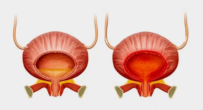 Vescica normale (a sinistra) e infiammazione della vescica con cistite (a destra)